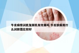 牛皮癬擦潤肌復(fù)顏乳有效果嗎 牛皮膚癬用什么潤膚霜比較好
