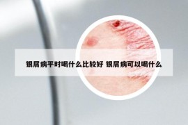 銀屑病平時喝什么比較好 銀屑病可以喝什么