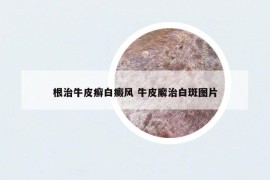 根治牛皮癬白癜風(fēng) 牛皮廨治白斑圖片