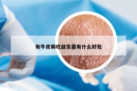 有牛皮癬吃益生菌有什么好處