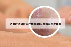 透血療法可以治療銀屑病嗎 血透治療皮膚病