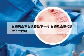 白癩風(fēng)會不會遺傳給下一代 白癩風(fēng)會隔代遺傳下一代嗎