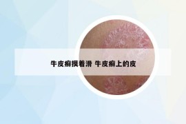 牛皮癬摸著滑 牛皮癬上的皮