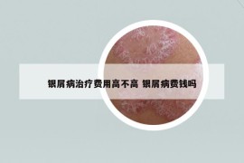 銀屑病治療費(fèi)用高不高 銀屑病費(fèi)錢嗎