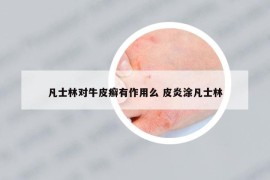 凡士林對牛皮癬有作用么 皮炎涂凡士林