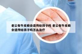 老公有牛皮癬會(huì)遺傳給孩子嗎 老公有牛皮癬會(huì)遺傳給孩子嗎怎么治療