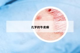 幾歲的牛皮癬