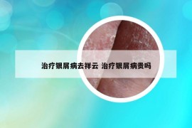 治療銀屑病去祥云 治療銀屑病貴嗎