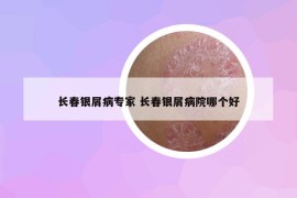 長春銀屑病專家 長春銀屑病院哪個好