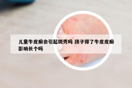 兒童牛皮癬會引起斑禿嗎 孩子得了牛皮皮癬影響長個嗎