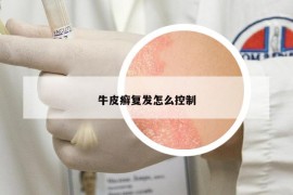 牛皮癬復發(fā)怎么控制