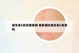 維生素b軟膏銀屑病 銀屑病吃維生素b有用嗎