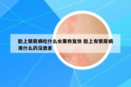 臉上銀屑病吃什么水果恢復(fù)快 臉上有銀屑病用什么藥沒(méi)激素