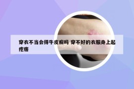 穿衣不當(dāng)會得牛皮癬嗎 穿不好的衣服身上起疙瘩