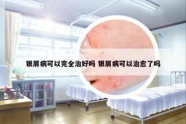 銀屑病可以完全治好嗎 銀屑病可以治愈了嗎