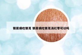 銀屑病吃銀耳 銀屑病吃銀耳湯紅棗可以嗎