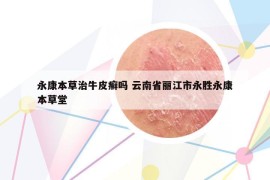 永康本草治牛皮癬嗎 云南省麗江市永勝永康本草堂