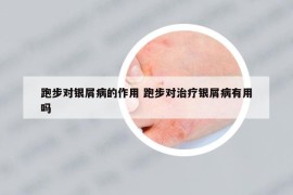 跑步對銀屑病的作用 跑步對治療銀屑病有用嗎