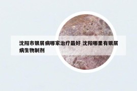 沈陽市銀屑病哪家治療最好 沈陽哪里有銀屑病生物制劑