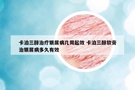 卡泊三醇治療銀屑病幾周起效 卡泊三醇軟膏治銀屑病多久有效