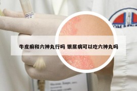 牛皮癬和六神丸行嗎 銀屑病可以吃六神丸嗎