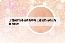 土瑾皮酊治牛皮癬有效嗎 土槿皮酊的功效與作用機(jī)理