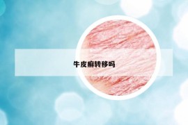 牛皮癬轉(zhuǎn)移嗎