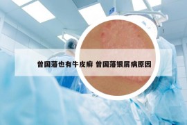 曾國藩也有牛皮癬 曾國藩銀屑病原因