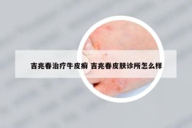 吉兆春治療牛皮癬 吉兆春皮膚診所怎么樣