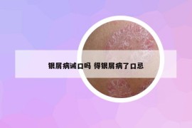 銀屑病誡口嗎 得銀屑病了口忌