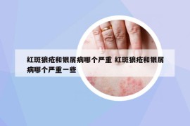 紅斑狼瘡和銀屑病哪個(gè)嚴(yán)重 紅斑狼瘡和銀屑病哪個(gè)嚴(yán)重一些