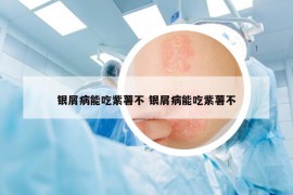 銀屑病能吃紫薯不 銀屑病能吃紫薯不