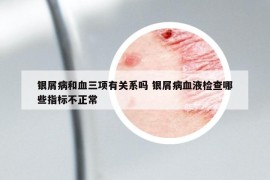 銀屑病和血三項(xiàng)有關(guān)系嗎 銀屑病血液檢查哪些指標(biāo)不正常