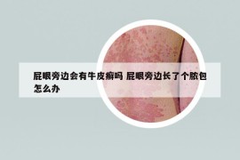 屁眼旁邊會(huì)有牛皮癬嗎 屁眼旁邊長(zhǎng)了個(gè)膿包怎么辦
