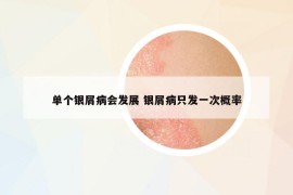 單個銀屑病會發(fā)展 銀屑病只發(fā)一次概率