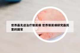 世界最先進治療銀屑病 世界銀屑病研究最厲害的國家