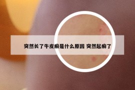 突然長(zhǎng)了牛皮癬是什么原因 突然起癬了