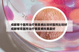 成都那個(gè)醫(yī)院治療銀屑病比較好醫(yī)院比較好 成都哪家醫(yī)院治療銀屑病效果最好