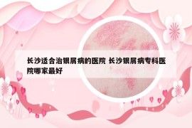 長沙適合治銀屑病的醫(yī)院 長沙銀屑病?？漆t(yī)院哪家最好