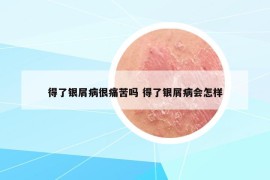 得了銀屑病很痛苦嗎 得了銀屑病會怎樣
