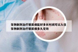 生物制劑治療銀屑病能好多長時間可以入住 生物制劑治療銀屑病多久見效
