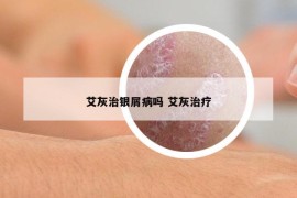 艾灰治銀屑病嗎 艾灰治療