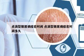 點滴型銀屑病痊愈時間 點滴型銀屑病痊愈時間多久