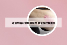 可信的臨汾銀屑病醫(yī)院 臨汾皮膚病醫(yī)院