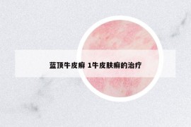 藍頂牛皮癬 1牛皮膚癬的治療