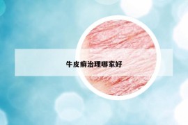 牛皮癬治理哪家好