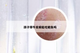 孩子得牛皮癬能吃鮑魚嗎