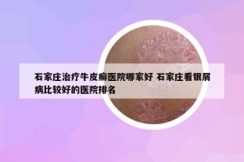 石家莊治療牛皮癬醫(yī)院哪家好 石家莊看銀屑病比較好的醫(yī)院排名