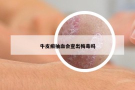 牛皮癬抽血會(huì)查出梅毒嗎