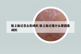 臉上胎記怎么形成的 臉上胎記是什么原因造成的